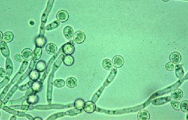 Infezioni da candida: causa di molte patologie